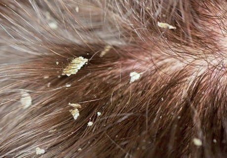 seberoik dermatit tedavisi nasıl yapılır? Yağlı egzama saçlarda nasıl görünür? https://huglero.com